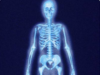 Bone Density, osteoporosis, osteopenia